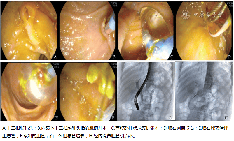 【专家笔谈·儿童内镜下逆行胰胆管造影·病例分享】内镜下逆行胰胆管