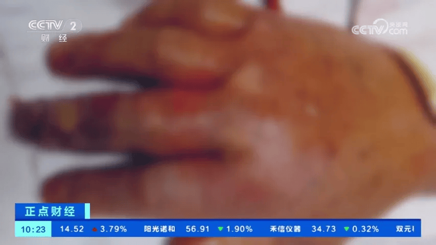 澳门近日报告一创伤弧菌死亡病例2024年4月20日,澳门卫生局接获1例