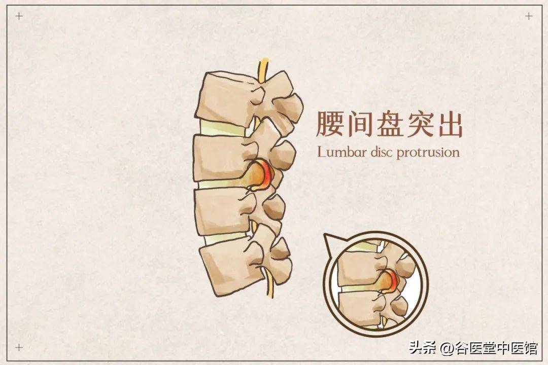谷医堂谷方益元:大部分肾虚型腰椎间盘突出这样艾灸调理有奇效!