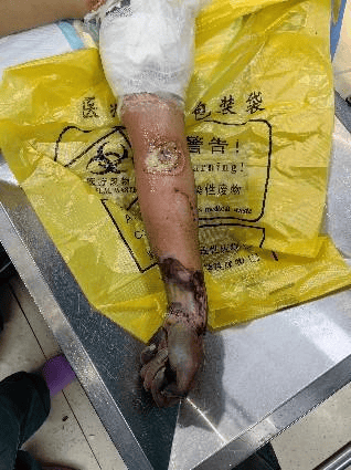 【危急】30岁男子撒尿触电,从高处摔下,全身烧伤,遭截肢