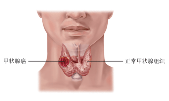 为什么会得甲状腺癌图片