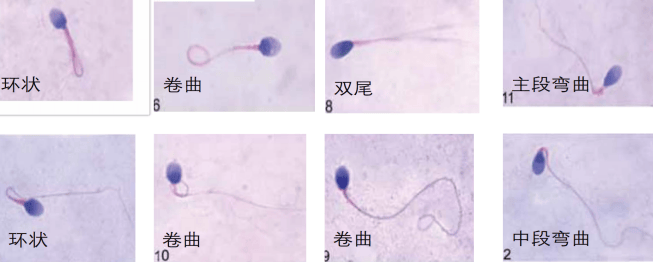 △头部异常的精子 4、正常形态精子＜4%，属于畸形精子症，可能无生育能力。△尾部异常的精子 当您拿到