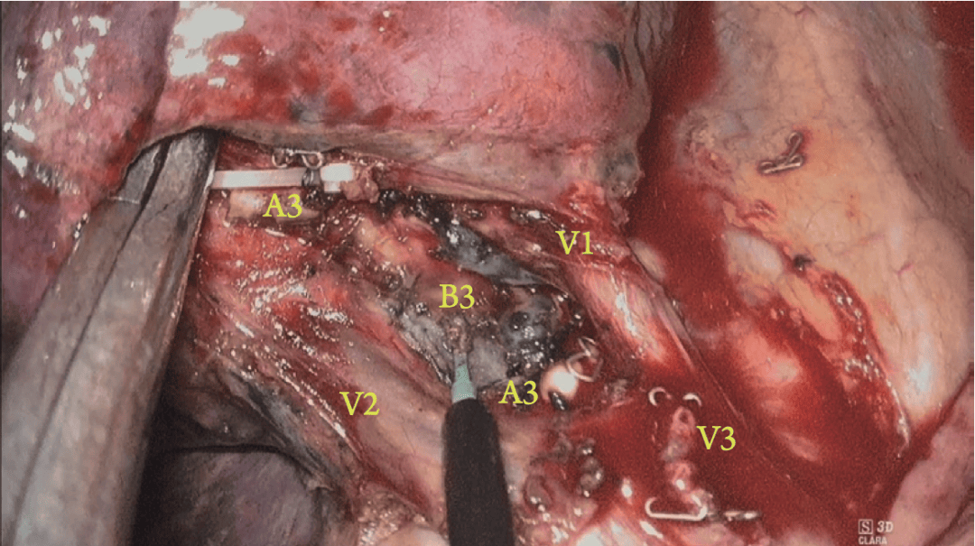 经肋间单孔胸腔镜右上肺前段切除术