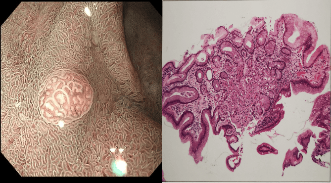 胃黏膜异位,胃上皮化生,布氏腺增生分不清?这篇文章教会你