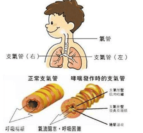 哮喘的症状早期症状图片