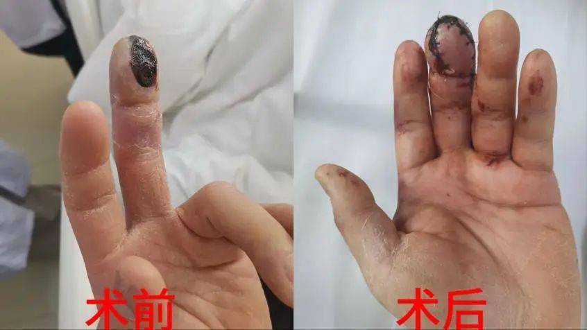 第二天,谢先生受伤的手指出现红肿和疼痛,他在家附近的诊所对伤口进行
