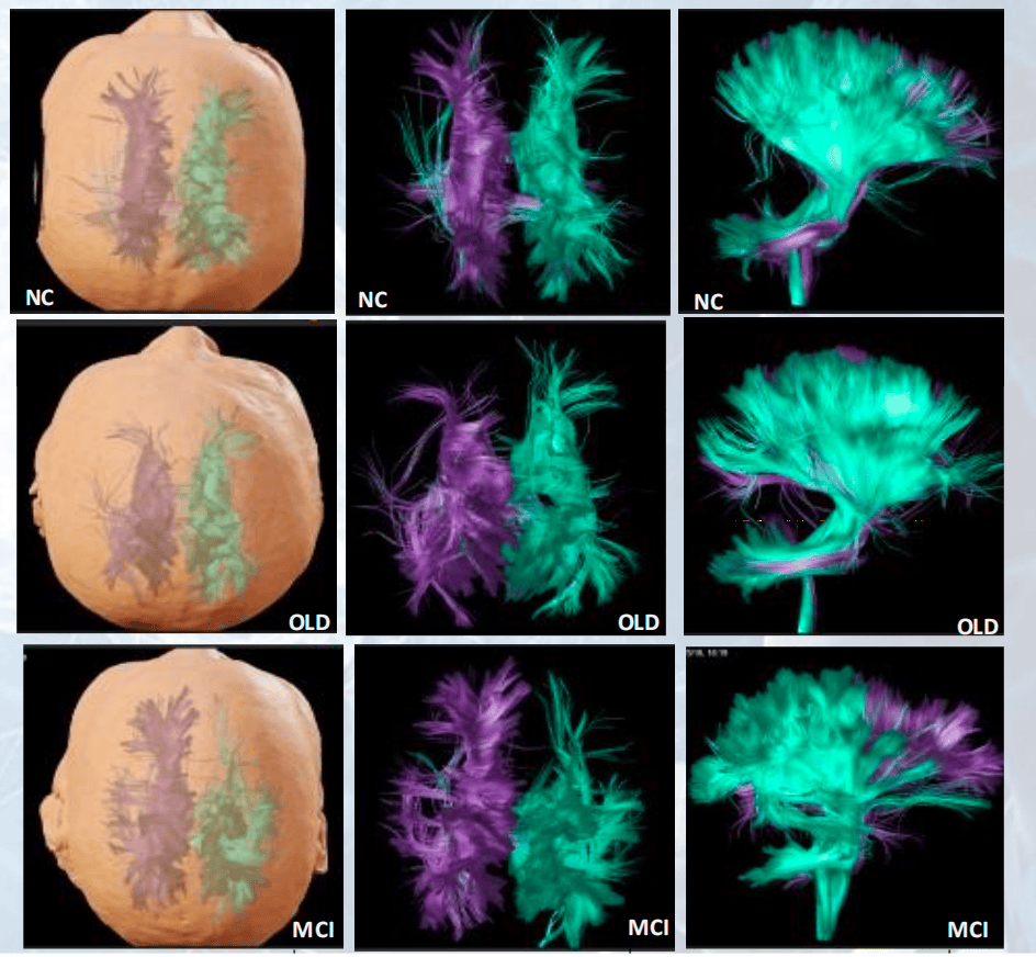 博医来特约 | 任廷文博士:如何应用脑图谱ai软件 通