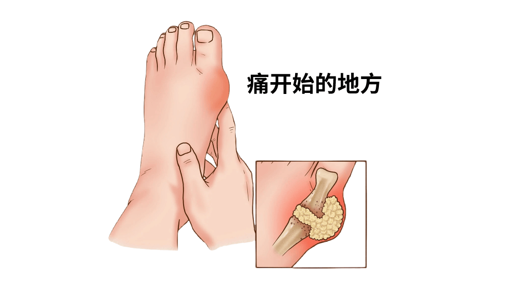 痛风部位大全图片