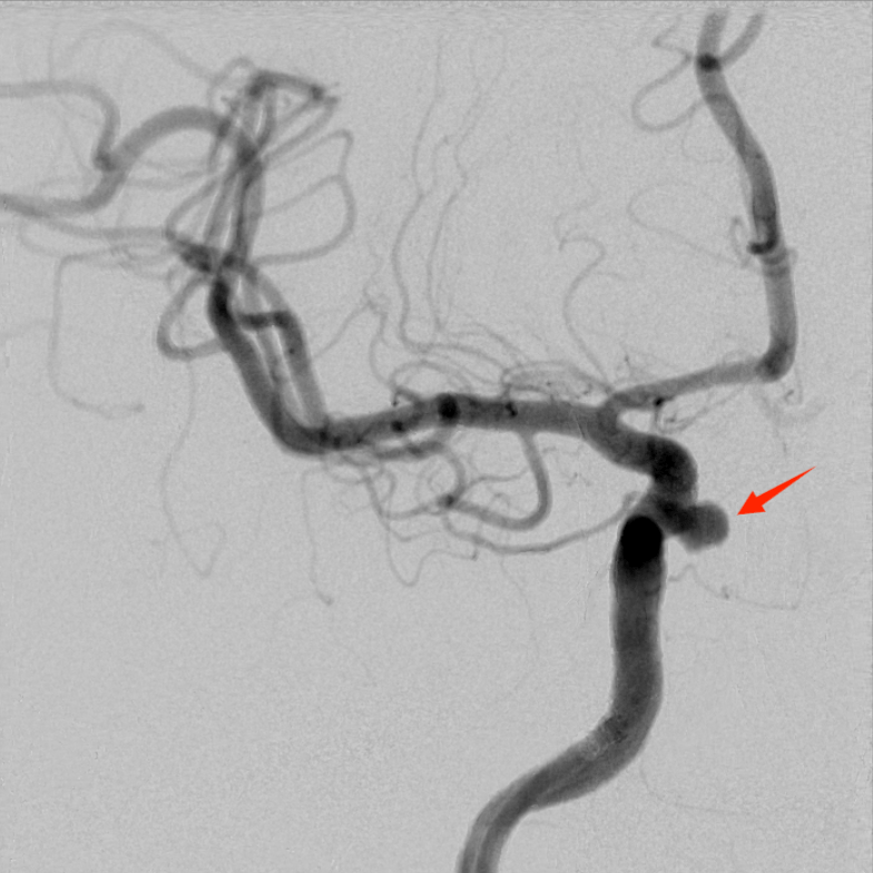 焕密网新生|海南首秀-高振忠教授团队:颈内动脉中小动脉瘤血流导向