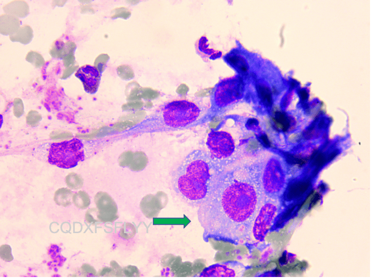尿β2微球蛋白图片