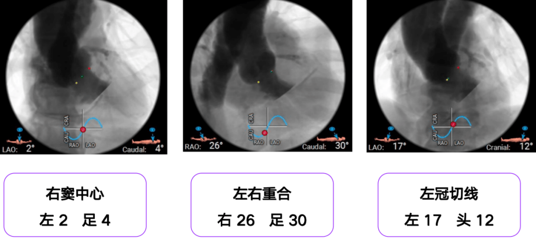 房室瓣钙化图片