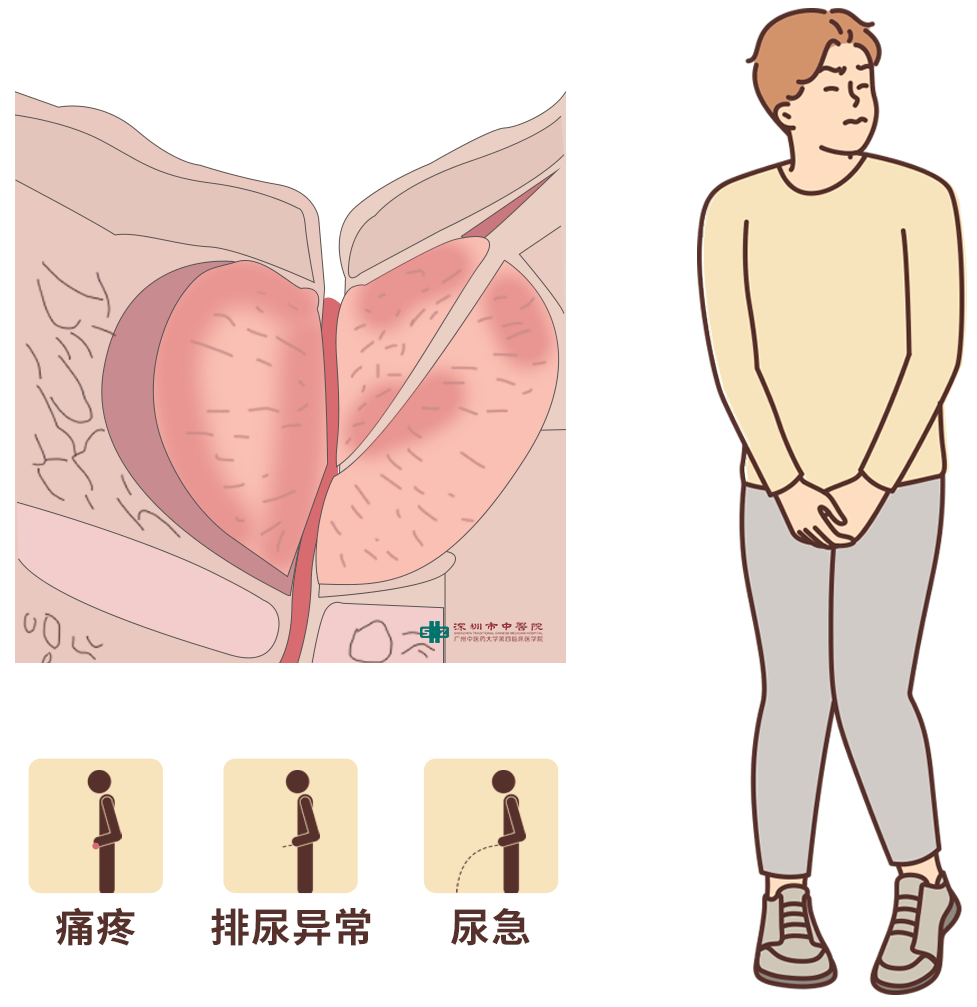 【中医疗法】小便不顺畅?男同胞们,真要当心前列腺!