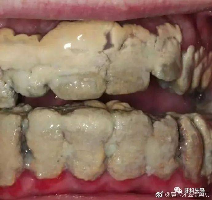 多年不洗牙,牙结石堆成钟乳石!是时候放下对洗牙的偏见了!