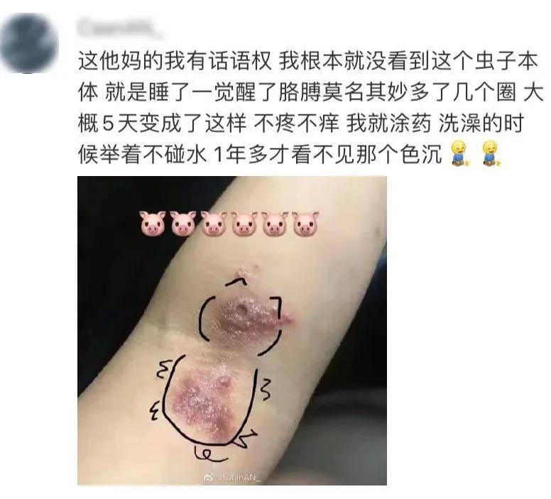 很多人曾中招,饶平特别多……_皮肤_虫子_詹先生