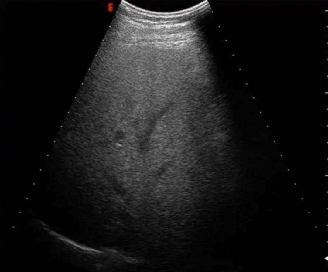 脂肪炎超声图片