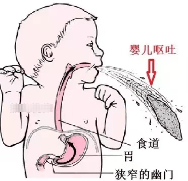宝宝出生两周后频繁呕吐?我院多学科团队协作成功救治肥幽婴儿