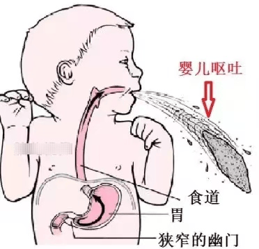 我院多学科团队协作成功救治肥幽婴儿