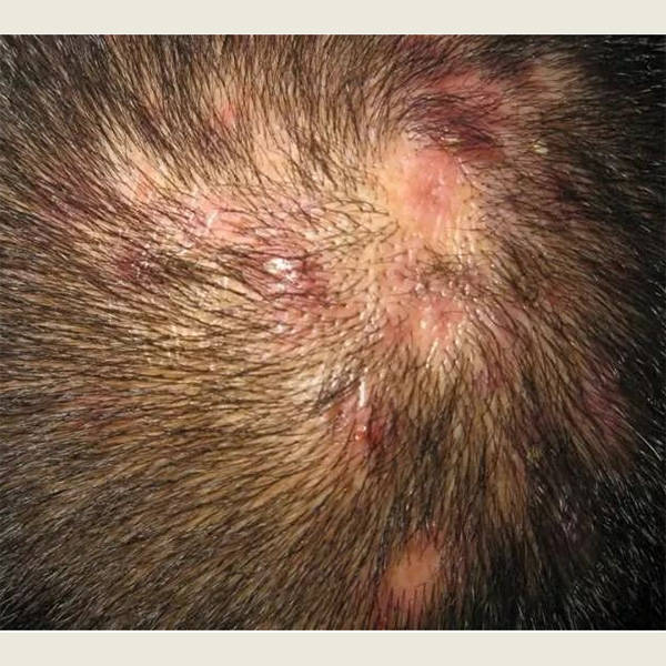 初中生头皮屑多又痒怎么办?去屑止痒洗发水女士介绍