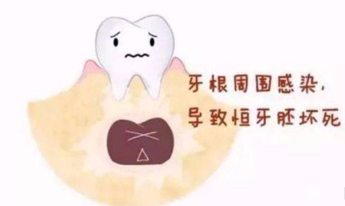 孩子乳牙龋齿怎么办?