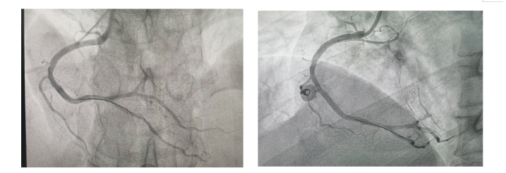 心脏内营养心肌的血管共有三根,分别是前降支动脉,回旋支动脉以及右