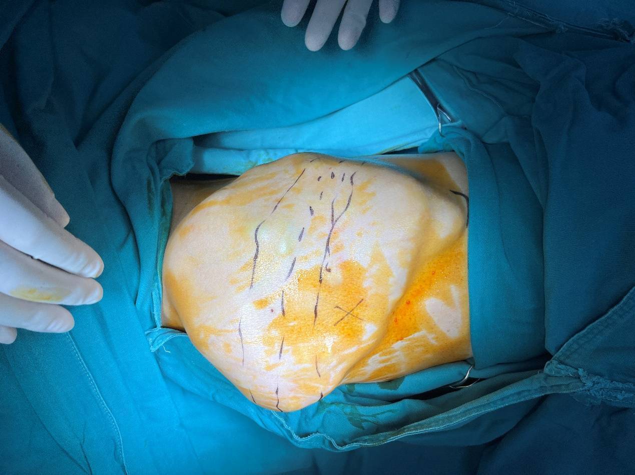 跨越生死线:胸腹部肿瘤被成功切除 患者迎来重生曙光