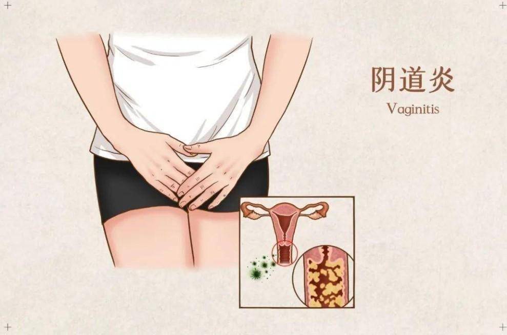 不同的炎症有不同的治疗药物,所以建议各位女性在出现异常后不要自行