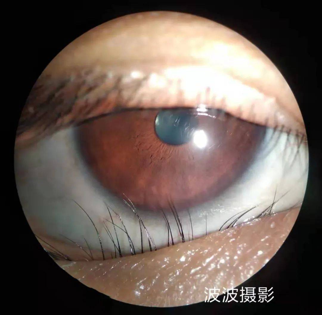 眼科图谱100张 | 裂隙灯下眼科图片分享_角膜_秘籍_医生