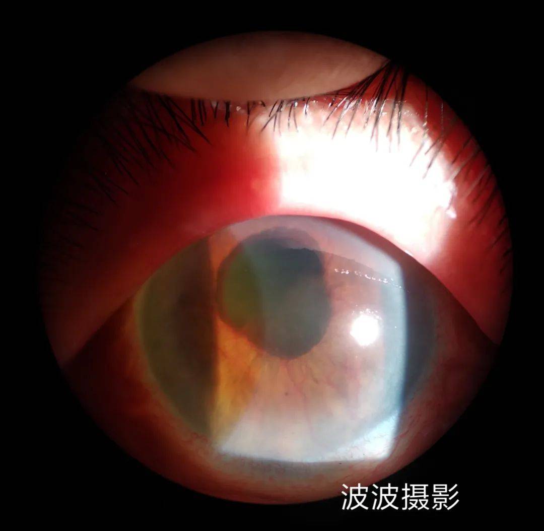 眼科图谱100张 | 裂隙灯下眼科图片分享_角膜_秘籍_医生