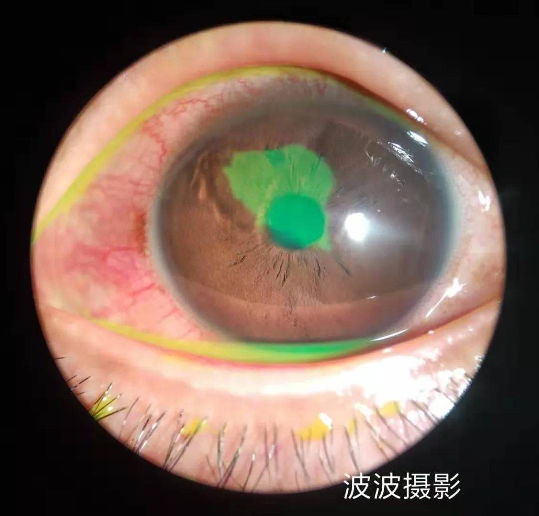 眼科图谱100张 | 裂隙灯下眼科图片分享_角膜_秘籍_医生