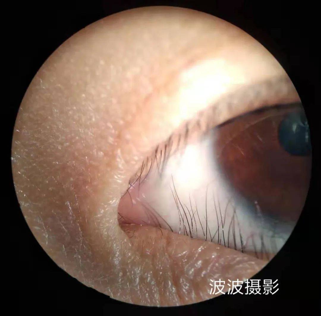 眼科图谱100张 | 裂隙灯下眼科图片分享_角膜_秘籍_医生
