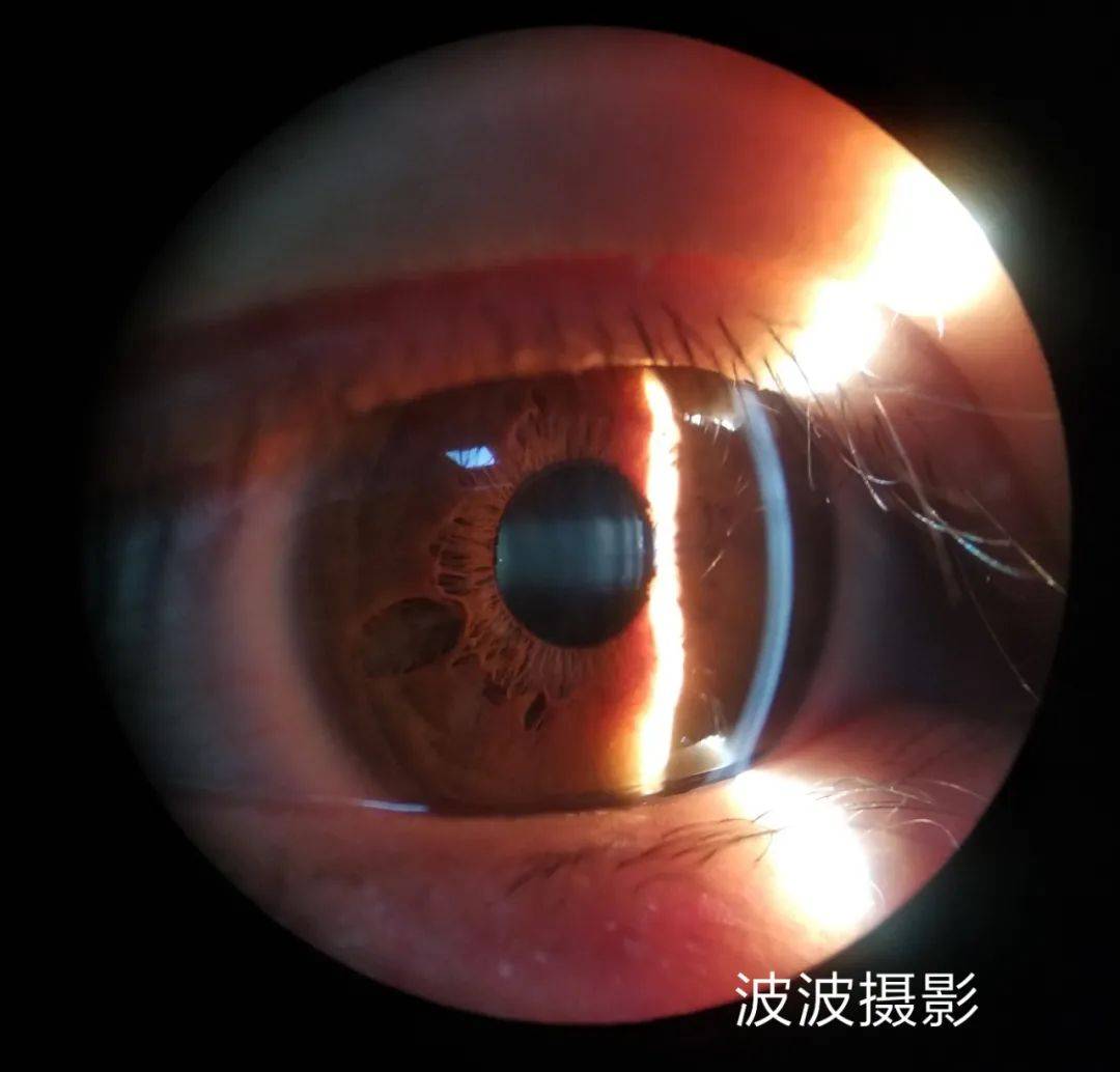 眼科图谱100张 | 裂隙灯下眼科图片分享_角膜_秘籍_医生