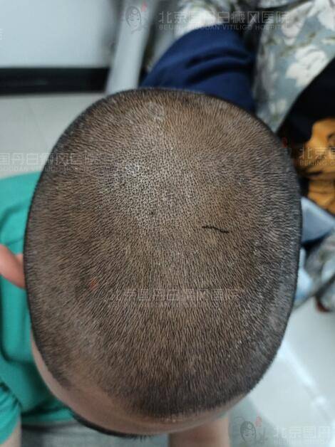 经过一段时间由内而外治疗,华华头部白斑基本复色.