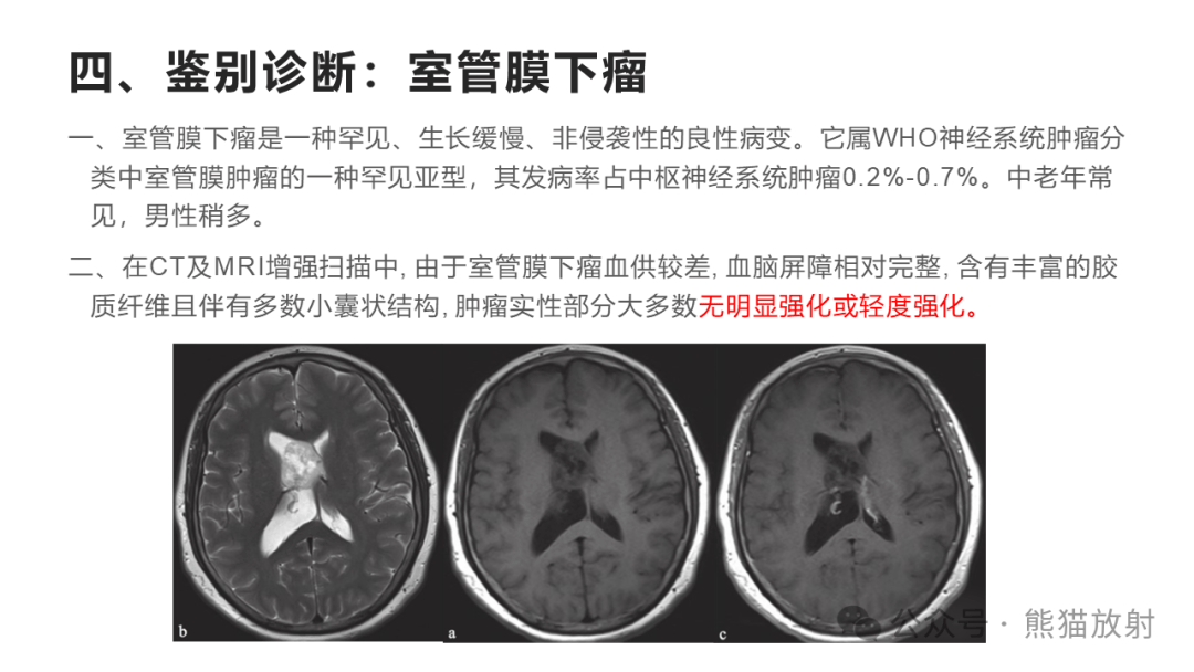 侧脑室影像图片图片