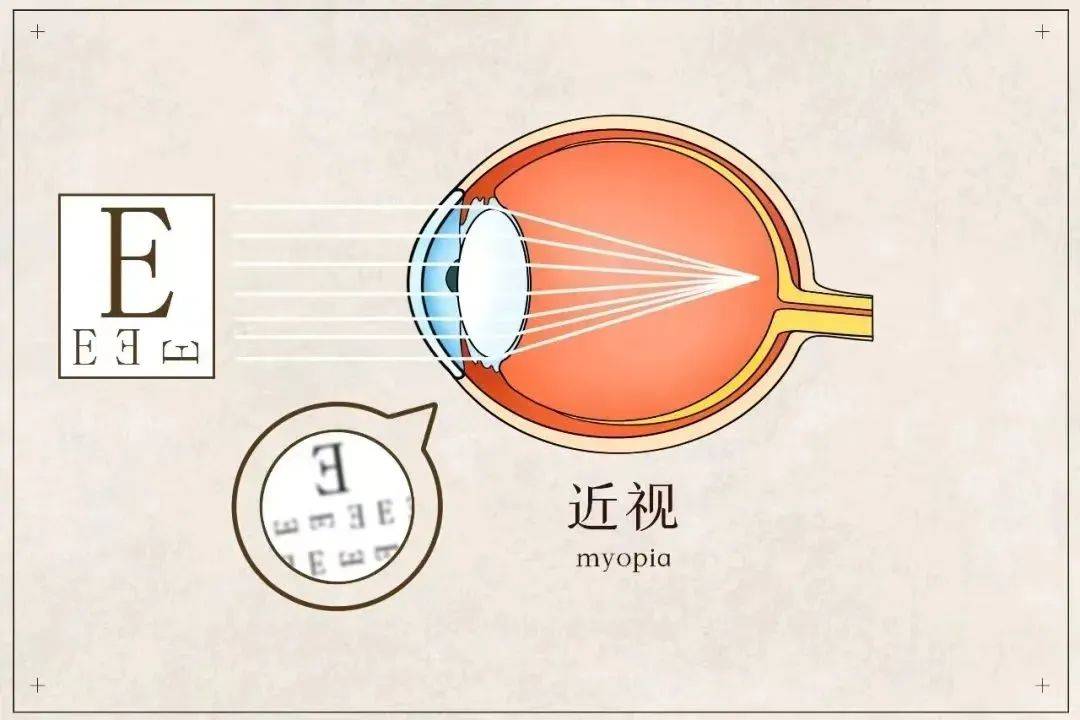 视网膜成像参数示意图图片