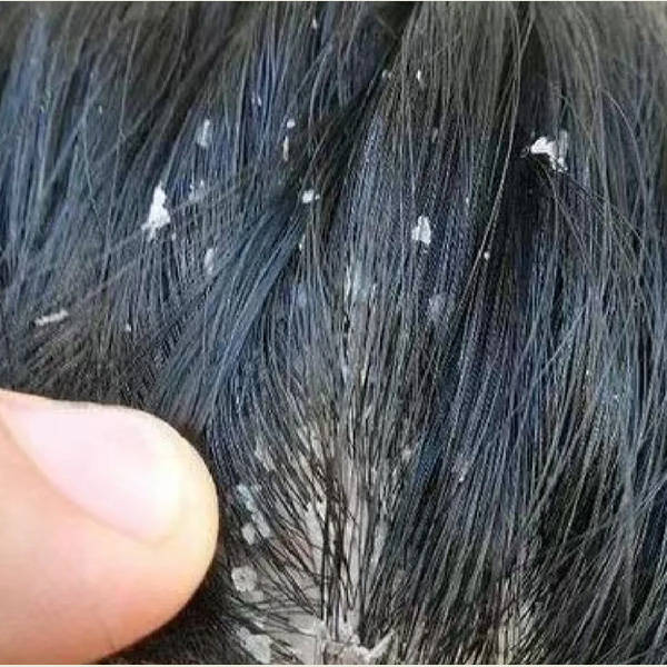 洗发产品,特别设计用于解决头皮问题,如头屑,头痒,毛囊炎和脂溢性皮炎