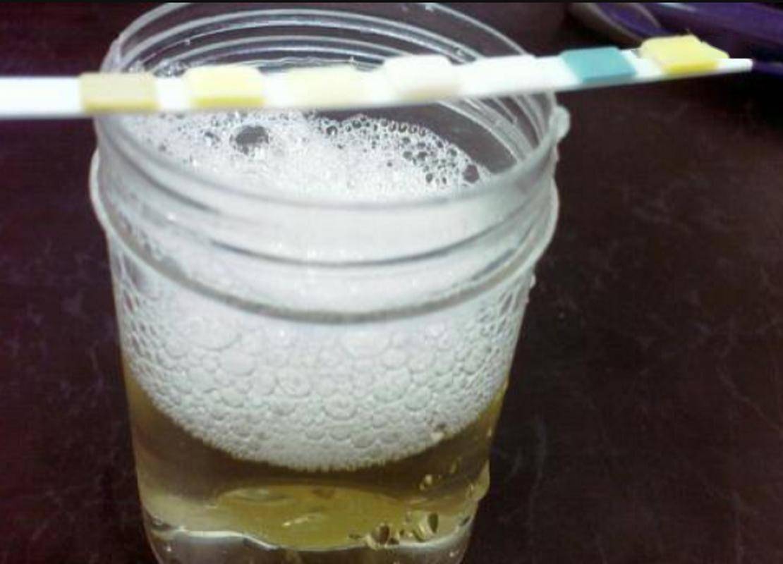 小便是糖尿病"显示器"?劝告:上厕所若有这3个表现,赶紧就诊