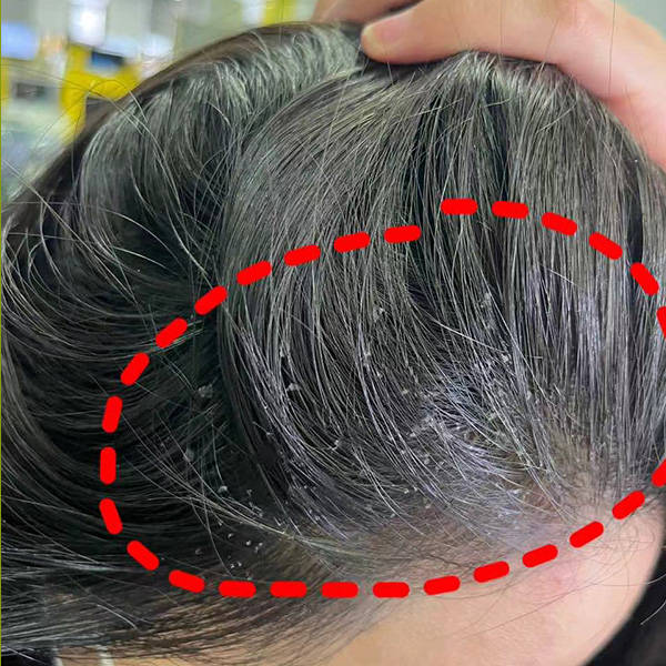 去头皮屑用什么洗发水最管用?清爽去屑止痒洗发露排行榜