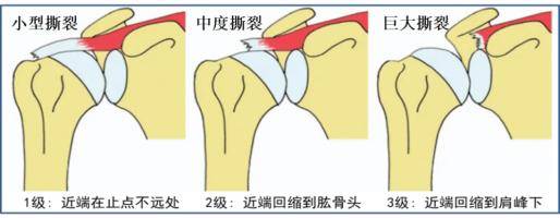 外侧裂位置图片