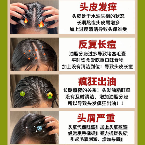 头皮问题产生原因如下:大块头屑,头痒,毛囊炎,小红疹,脂溢性皮炎可能