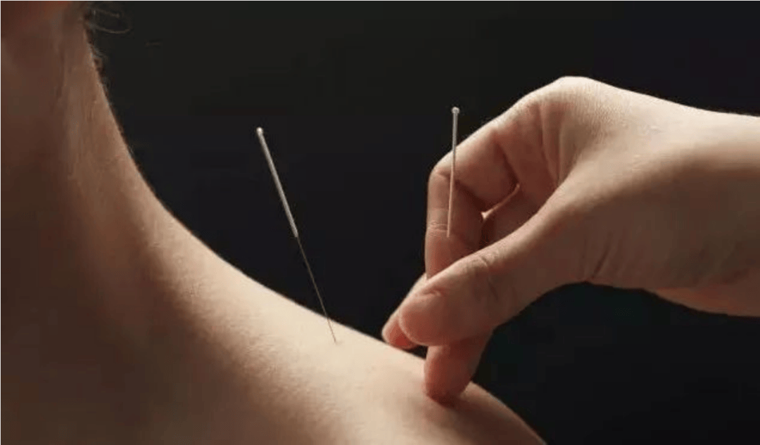 【健康科普】一觉醒来嘴歪眼斜,中医针灸"早"支招