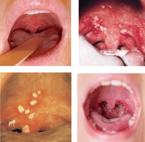 小孩咽喉炎症状及表现图片