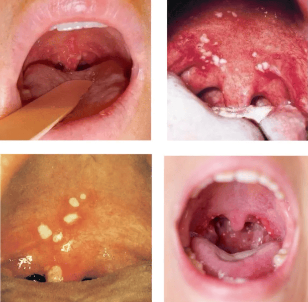 传染性强!中招后喉咙"长泡泡",出现这些症状千万要注意