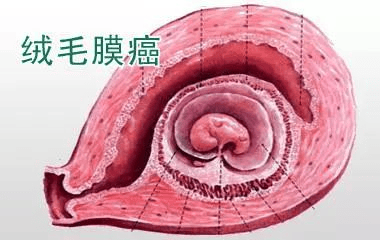 【科普】超声对"鬼胎"识别