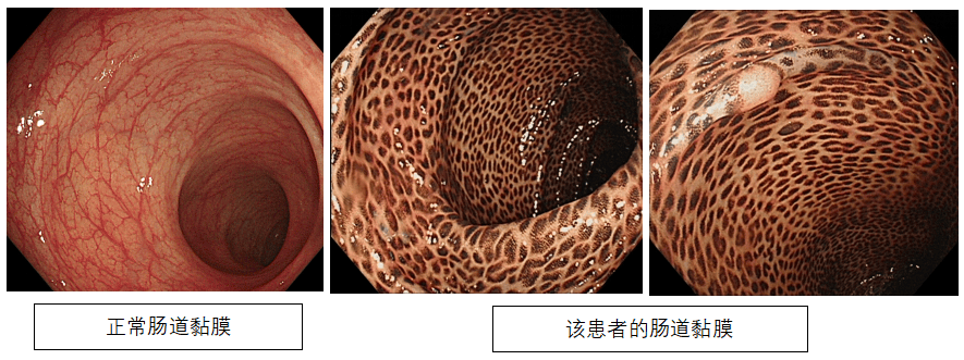 拉出一整条肠粘膜图片