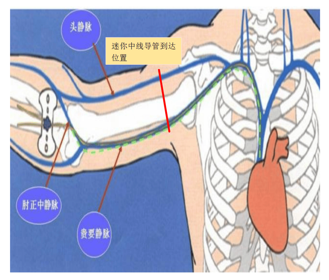 导管子的正确姿势图片