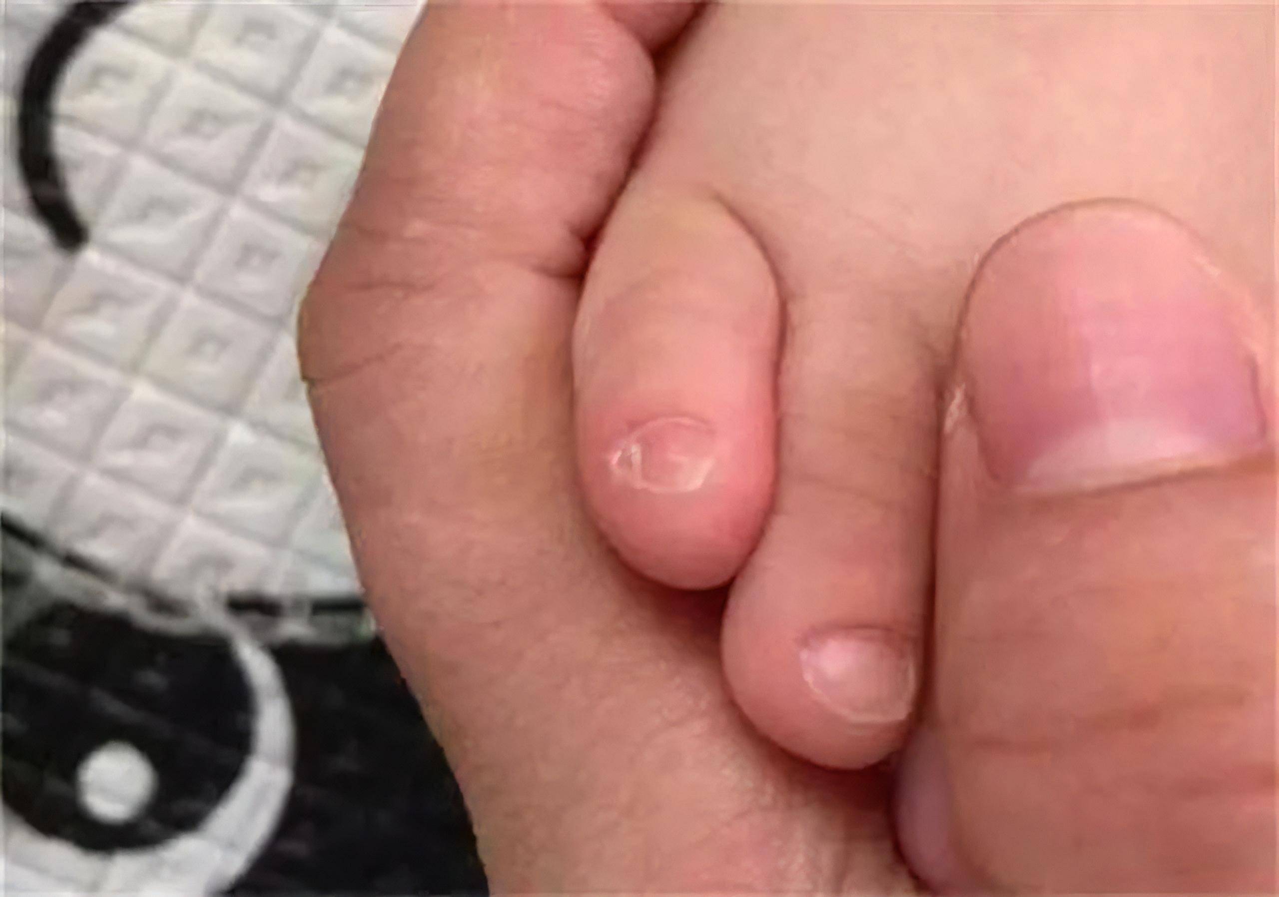 小脚趾甲分成两瓣的,才是纯种汉族血统?事实上是这样吗?