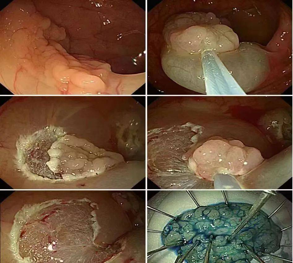 直径大于2厘米,表面有出血或溃疡,活动度差的息肉可能是恶性的,需要