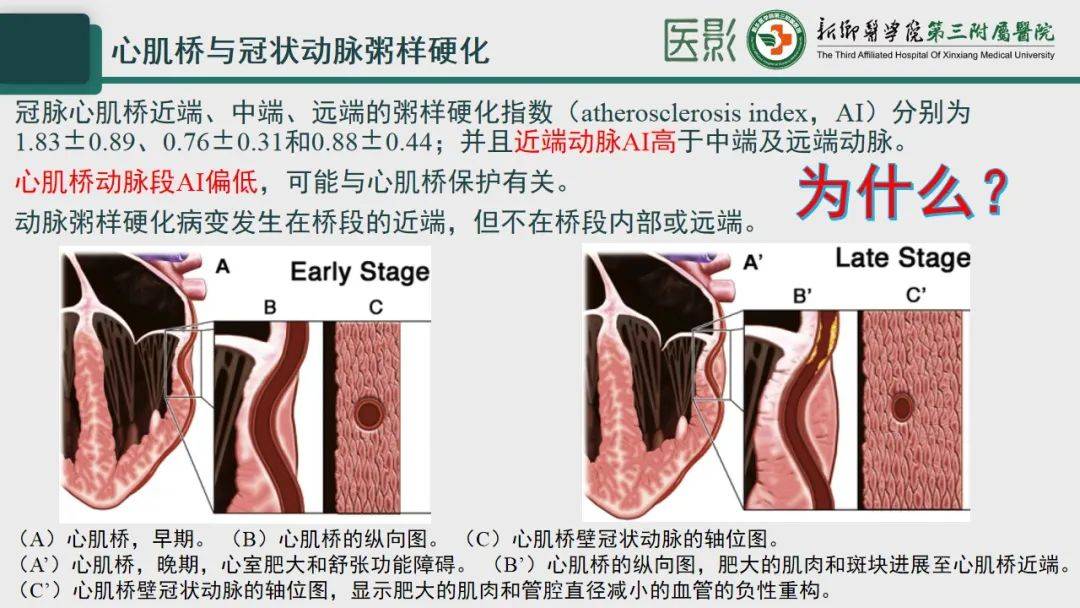 冠脉cta—心肌桥诊断要点