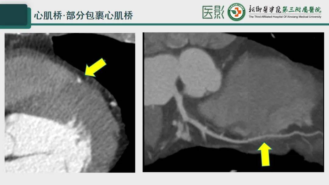 冠脉cta—心肌桥诊断要点