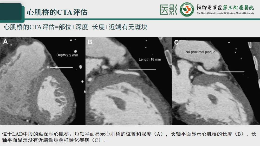 冠脉cta—心肌桥诊断要点